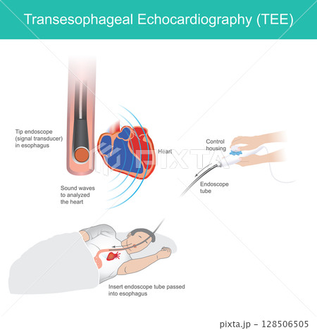 illustrates the Transesophageal Echocardiography (TEE) procedure, a diagnostic medical imaging technique used to obtain detailed images of the heart. 128506505