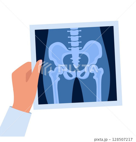 XRay of hip joint pelvis human bones anatomy orthopedic medical diagnostic. Roentgen shot in doctors hand. Vector illustration. 128507217