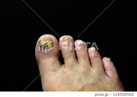 足 指 爪 水虫 足 指 爪 水虫 128509508