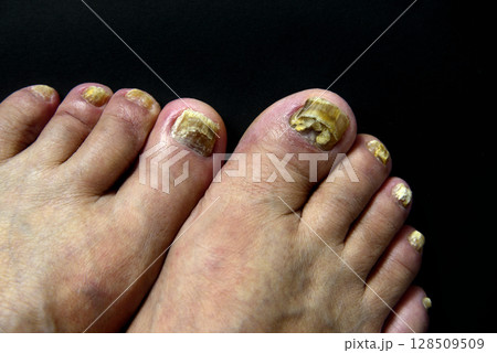 足 指 爪 水虫 足 指 爪 水虫 128509509