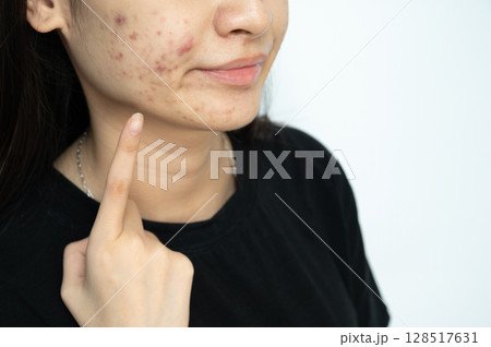 Cropped shot of Asian woman pointing to acne problems on her face. Inflamed acne consists of swelling, redness, and pores that are deeply clogged with bacteria, oil, and dead skin cells. 128517631