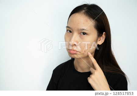 Serious Asian woman pointing to acne problems on her face. Inflamed acne consists of swelling, redness, and pores that are deeply clogged with bacteria, oil, and dead skin cells. 128517853