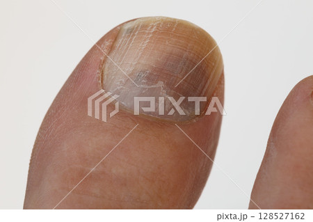 足の親指の爪下血腫 足の親指の爪下血腫 128527162