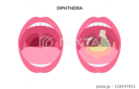 Diphtheria oral disease Diphtheria oral disease 128547652