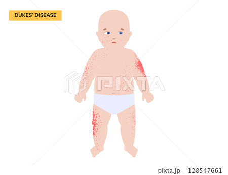 Dukes disease poster 128547661