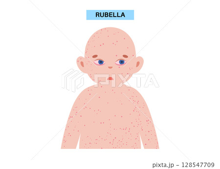 Rubella or German measles 128547709