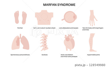 Marfan syndrome poster 128549980