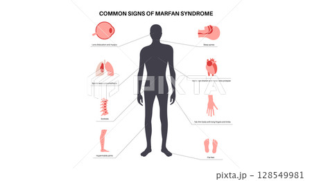Marfan syndrome poster 128549981