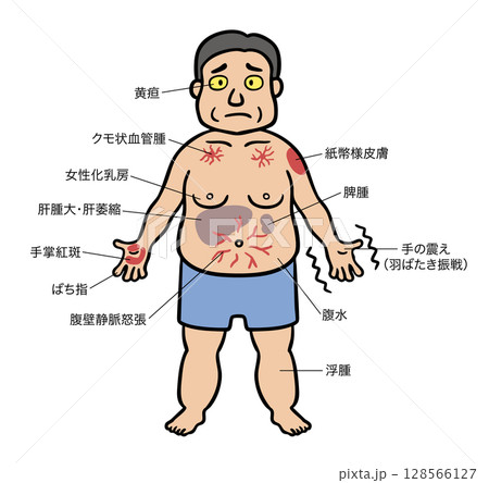 肝硬変の症状が出ている中年男性のイラスト 128566127