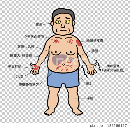 肝硬変の症状が出ている中年男性のイラスト 128566127