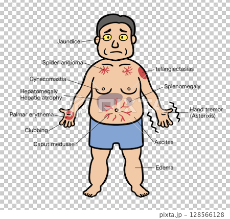 肝硬変の症状が出ている中年男性のイラスト 128566128