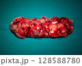 Resected Astrocytoma Brain Tumor Specimen 128588780