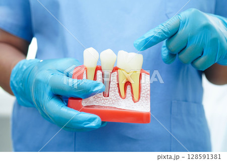 Doctor hold dental implant, artificial tooth roots into jaw, root canal of dental treatment, gum disease, teeth model for dentist studying about dentistry. Doctor hold dental implant, artificial tooth roots into jaw, root canal of dental treatment, gum disease, teeth model for dentist studying about dentistry. 128591381