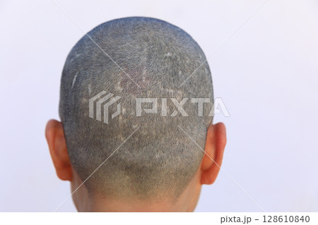 Rear view of bald woman head Rear view of bald woman head 128610840