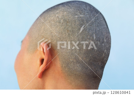 Side view of bald woman head Side view of bald woman head 128610841