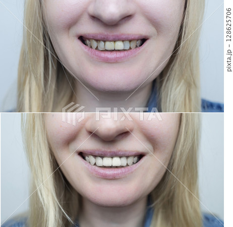 Successful restoration of front incisors. High-quality before and after photos of artistic dental restoration. Tooth build-up and reconstruction for a healthy smile. Successful restoration of front incisors. High-quality before and after photos of artistic dental restoration. Tooth build-up and reconstruction for a healthy smile. 128625706
