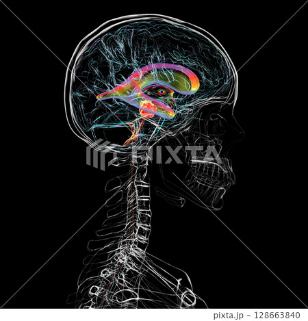 A brain tumor causing hydrocephalus, 3D illustration 128663840