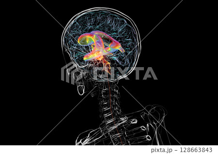 A brain tumor causing hydrocephalus, 3D illustration A brain tumor causing hydrocephalus, 3D illustration 128663843