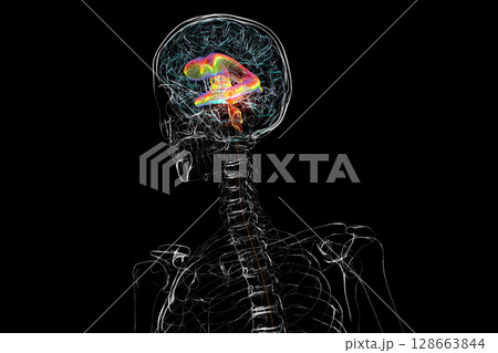 A brain tumor causing hydrocephalus, 3D illustration A brain tumor causing hydrocephalus, 3D illustration 128663844
