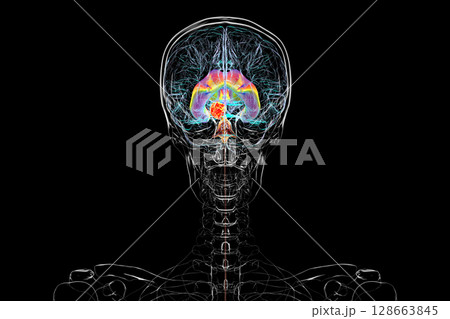 A brain tumor causing hydrocephalus, 3D illustration 128663845