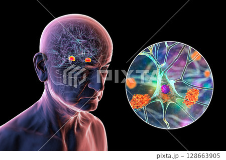 Senior person with Alzheimer's disease, 3D illustration showing highlighted amygdala and close-up view of amygdala neurons affected by Alzheimer' pathology, including tau tangles and amyloid plaques 128663905