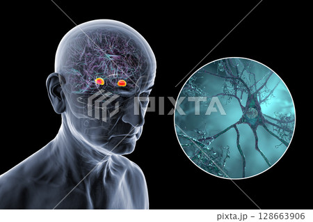 Senior person with Alzheimer's disease, 3D illustration showing highlighted amygdala and close-up view of amygdala neurons affected by Alzheimer' pathology, including tau tangles and amyloid plaques 128663906