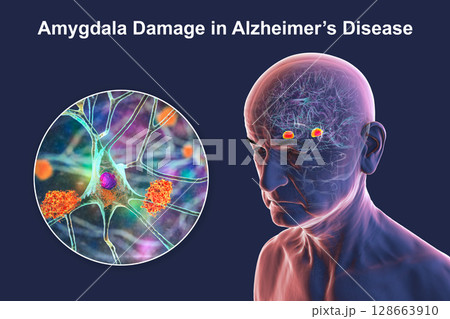 Senior person with Alzheimer's disease, 3D illustration showing highlighted amygdala and close-up view of amygdala neurons affected by Alzheimer' pathology, including tau tangles and amyloid plaques 128663910