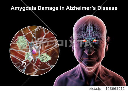 Senior person with Alzheimer's disease, 3D illustration showing highlighted amygdala and close-up view of amygdala neurons affected by Alzheimer' pathology, including tau tangles and amyloid plaques 128663911