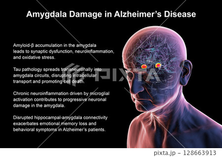 Senior person with Alzheimer's disease, 3D illustration showing highlighted amygdala, a region involved in emotion and memory, commonly affected by neurodegeneration in Alzheimer's. 128663913