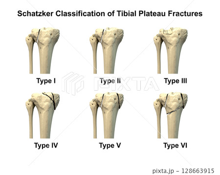 Schatzker classification of tibial plateau fractures, types I to VI, used to assess fracture patterns and severity in proximal tibia injuries, 3D illustration 128663915
