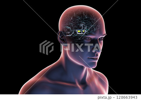 Human brain with degenerated substantia nigra in Parkinson's disease, showing loss of pigmented neurons in the midbrain related to motor dysfunction, 3D illustration. Human brain with degenerated substantia nigra in Parkinson's disease, showing loss of pigmented neurons in the midbrain related to motor dysfunction, 3D illustration. 128663943