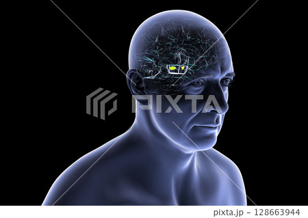 Human brain with degenerated substantia nigra in Parkinson's disease, showing loss of pigmented neurons in the midbrain related to motor dysfunction, 3D illustration. Human brain with degenerated substantia nigra in Parkinson's disease, showing loss of pigmented neurons in the midbrain related to motor dysfunction, 3D illustration. 128663944