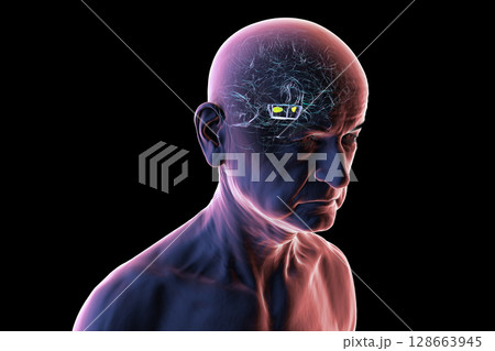 Human brain with degenerated substantia nigra in Parkinson's disease, showing loss of pigmented neurons in the midbrain related to motor dysfunction, 3D illustration. 128663945