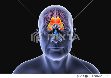 Enlarged lateral ventricles of the brain, 3D illustration 128664027