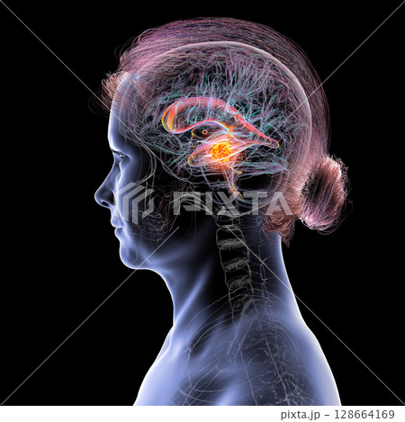 A brain tumor causing hydrocephalus, 3D illustration A brain tumor causing hydrocephalus, 3D illustration 128664169