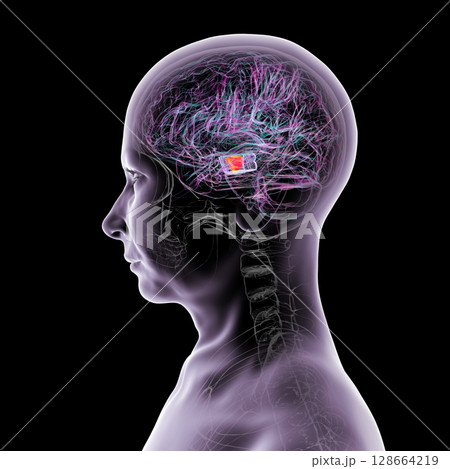 Human brain with highlighted substantia nigra in the midbrain, a key structure involved in movement regulation and affected in Parkinson's disease, 3D illustration. Human brain with highlighted substantia nigra in the midbrain, a key structure involved in movement regulation and affected in Parkinson's disease, 3D illustration. 128664219