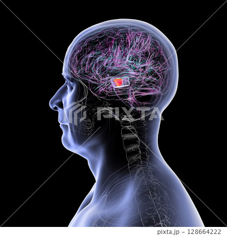Human brain with highlighted substantia nigra in the midbrain, a key structure involved in movement regulation and affected in Parkinson's disease, 3D illustration. 128664222