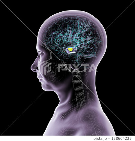 Human brain with degenerated substantia nigra in Parkinson's disease, showing loss of pigmented neurons in the midbrain related to motor dysfunction, 3D illustration. Human brain with degenerated substantia nigra in Parkinson's disease, showing loss of pigmented neurons in the midbrain related to motor dysfunction, 3D illustration. 128664225