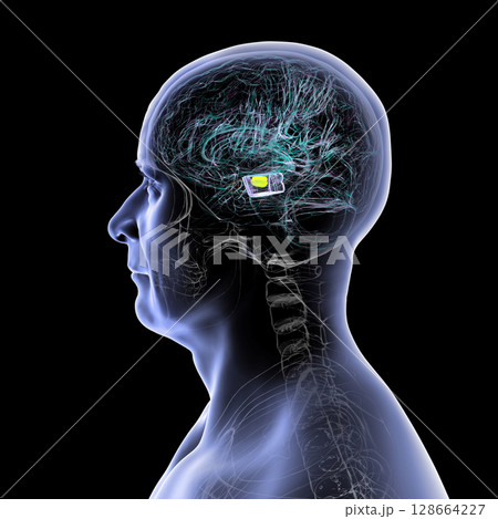 Human brain with degenerated substantia nigra in Parkinson's disease, showing loss of pigmented neurons in the midbrain related to motor dysfunction, 3D illustration. 128664227