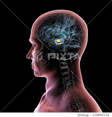 Human brain with degenerated substantia nigra in Parkinson's disease, showing loss of pigmented neurons in the midbrain related to motor dysfunction, 3D illustration. 128664228