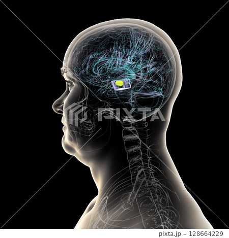 Human brain with degenerated substantia nigra in Parkinson's disease, showing loss of pigmented neurons in the midbrain related to motor dysfunction, 3D illustration. 128664229