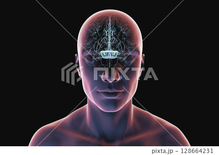 Human brain with degenerated substantia nigra in Parkinson's disease, showing loss of pigmented neurons in the midbrain related to motor dysfunction, 3D illustration. Human brain with degenerated substantia nigra in Parkinson's disease, showing loss of pigmented neurons in the midbrain related to motor dysfunction, 3D illustration. 128664231