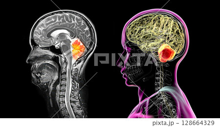 Cerebellum, 3D illustration and colored MRI composite showing brain anatomy with highlighted cerebellum, important for coordination, balance, and motor control. 128664329