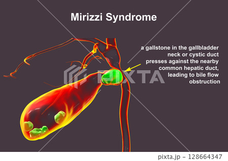 Mirizzi syndrome, 3D illustration showing compression of the common hepatic duct by an impacted gallstone in the cystic duct, causing obstructive jaundice and inflammation. 128664347