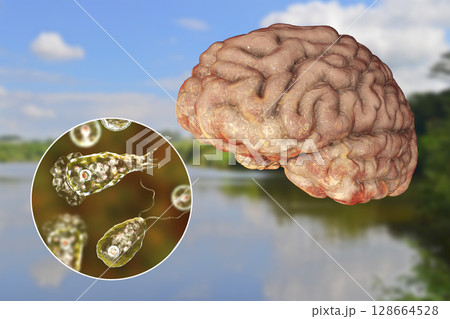 Brain-eating amoeba infection, naegleriasis Brain-eating amoeba infection, naegleriasis 128664528