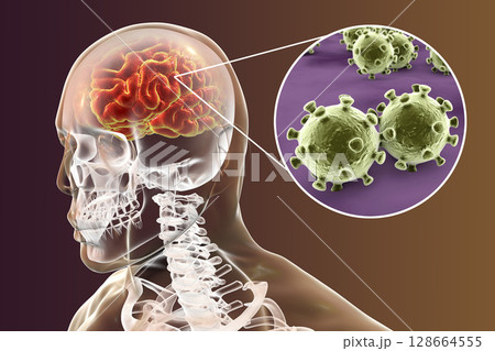 Viral encephalitis, medical concept 128664555