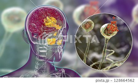 Rhinocerebral mucormycosis, a brain lesion and sinusitis caused by fungi Mucor 128664562