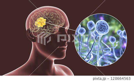 Brain mucormycosis, a brain lesion caused by fungi Mucor Brain mucormycosis, a brain lesion caused by fungi Mucor 128664563