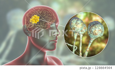 Brain mucormycosis, a brain lesion caused by fungi Mucor 128664564