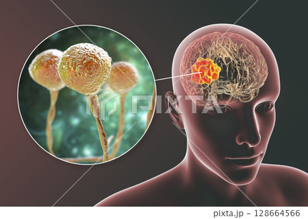 Brain mucormycosis, a brain lesion caused by fungi Mucor, also known as black fungus Brain mucormycosis, a brain lesion caused by fungi Mucor, also known as black fungus 128664566